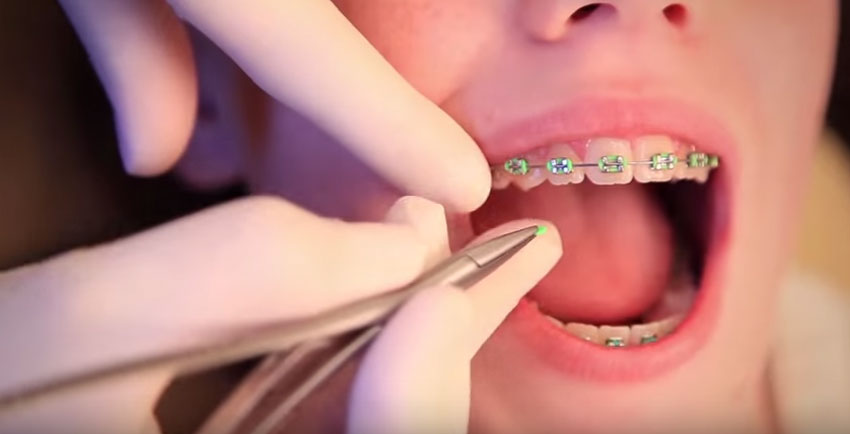 Coloured Braces a Brisbane Smile Makeover Fashion Statement